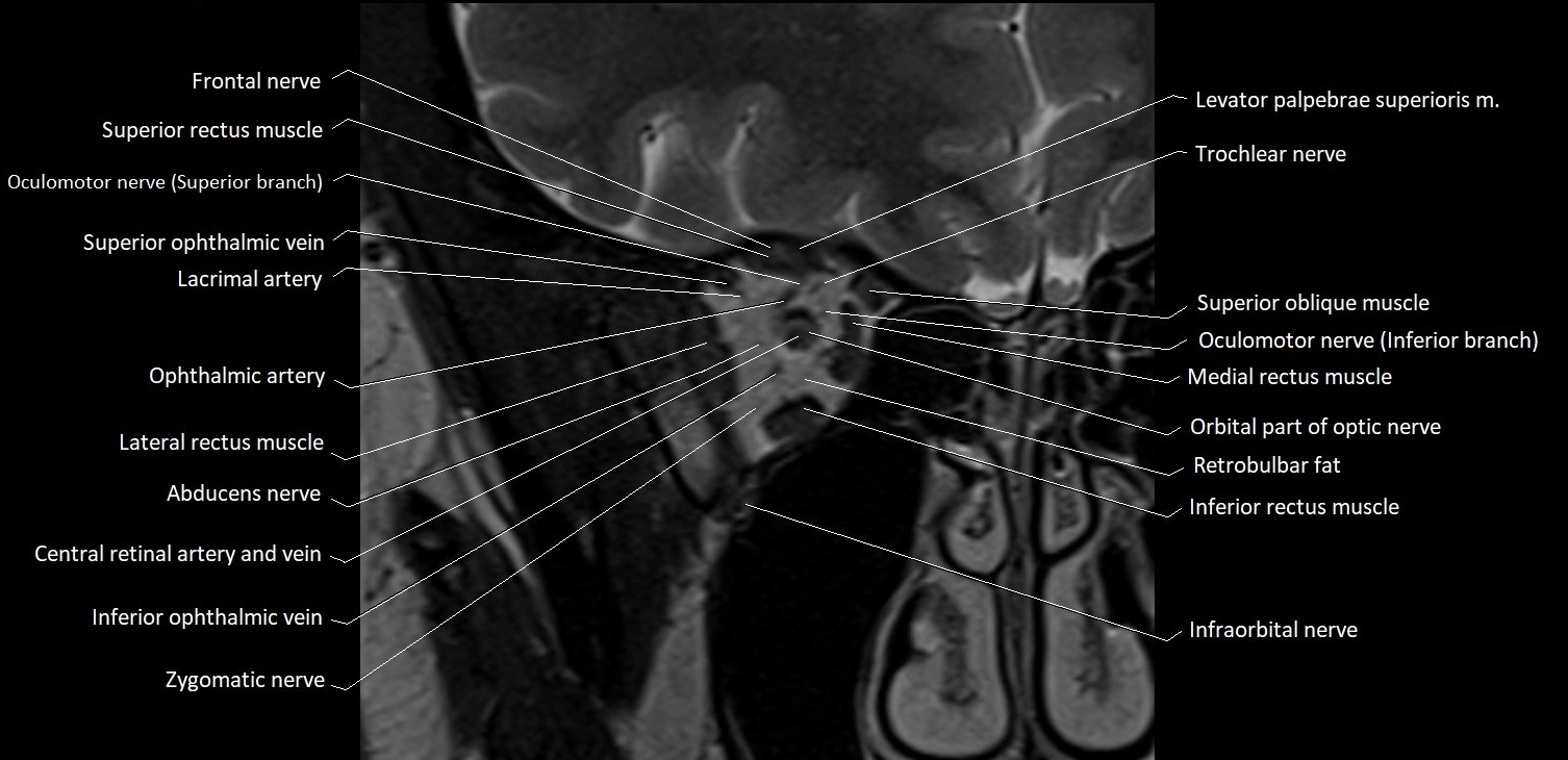 MRI Orbit coronal cross sectional anatomy image 11.webp